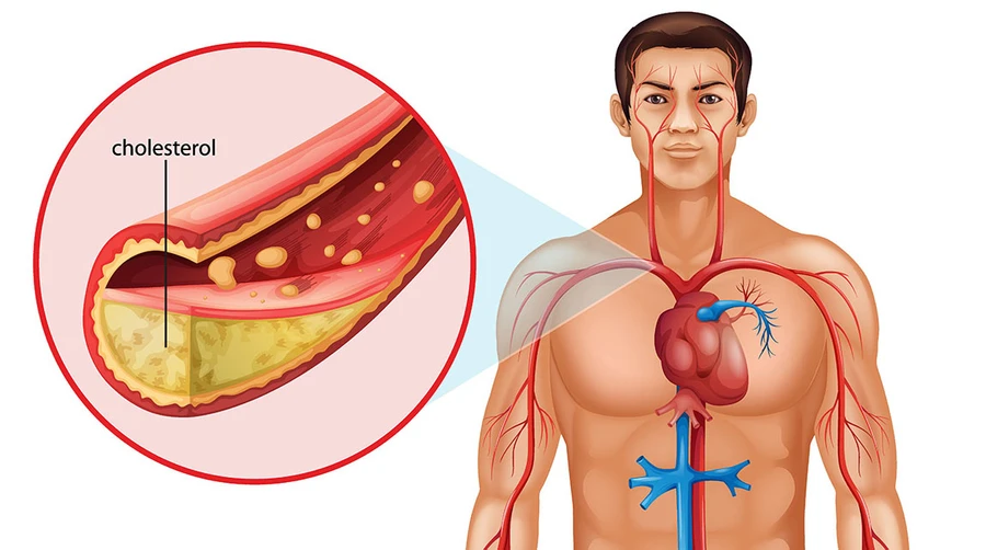 Cholesterol xấu và stress không còn đáng sợ?