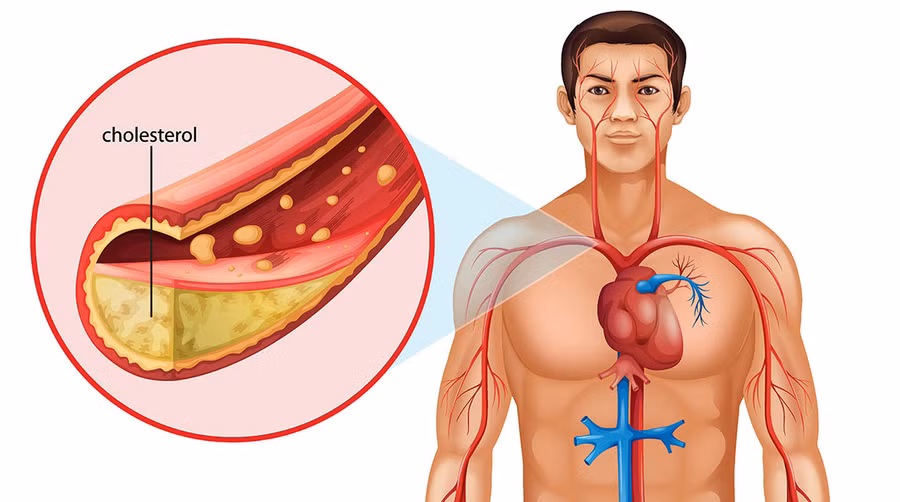 Cholesterol xấu và stress không còn đáng sợ?