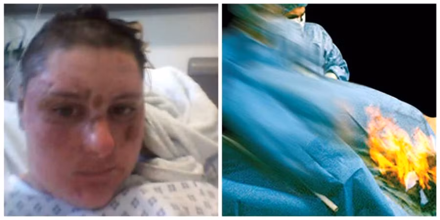 Nữ bệnh nhân bị bỏng nặng chỉ vì lỡ xì hơi trong lúc đang trị liệu tia laser.