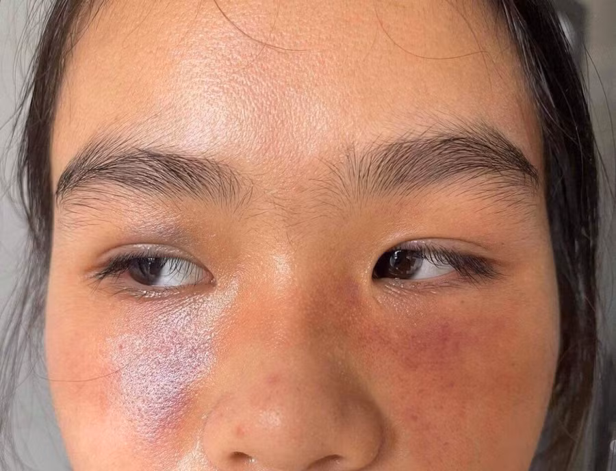 Khuôn mặt em V. sau khi bị hành hung.