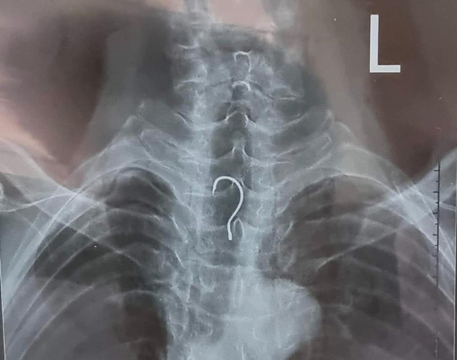 Hình ảnh chiếc lưỡi câu mắc kẹt trong thực quản bệnh nhân.