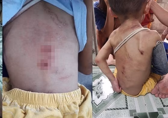 Vết thương trên người bé trai.