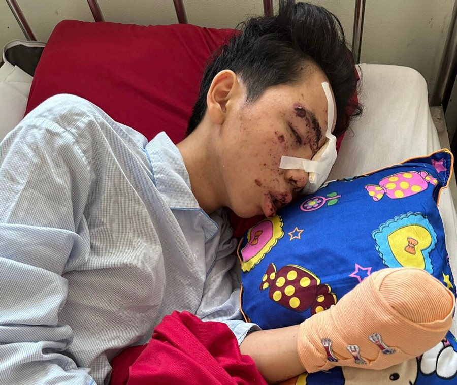 Bàn tay trái của Tú bị hoại tử sau vụ nổ. Bàn tay trái của Tú bị hoại tử sau vụ nổ.