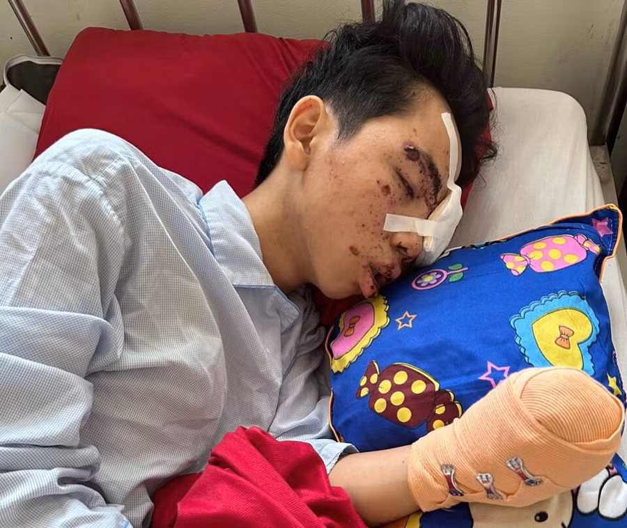 Bàn tay trái của Tú bị hoại tử sau vụ nổ.