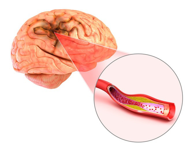 Đột quỵ não và vai trò của chụp cộng hưởng từ (MRI) trong tầm soát đột quỵ ảnh 1 Đột quỵ não và vai trò của chụp cộng hưởng từ (MRI) trong tầm soát đột quỵ - ảnh 1