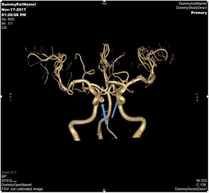 Đột quỵ não và vai trò của chụp cộng hưởng từ (MRI) trong tầm soát đột quỵ ảnh 2 Đột quỵ não và vai trò của chụp cộng hưởng từ (MRI) trong tầm soát đột quỵ - ảnh 2