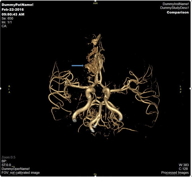 Đột quỵ não và vai trò của chụp cộng hưởng từ (MRI) trong tầm soát đột quỵ ảnh 4 Đột quỵ não và vai trò của chụp cộng hưởng từ (MRI) trong tầm soát đột quỵ - ảnh 4