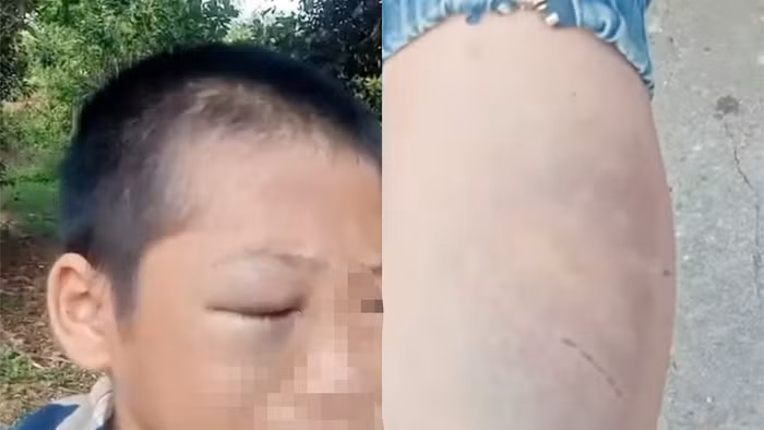 Bé trai bị nhiều vết bầm tím trên cơ thể. (Ảnh cắt từ clip)