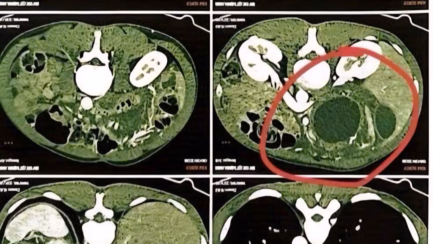 Hình ảnh phim chụp CT scan ổ bụng của bệnh nhân T.K. 