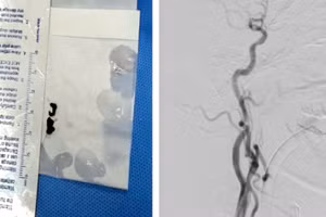 Động mạch cảnh ở não bệnh nhân sau can thiệp lấy huyết khối kèm đặt stent.