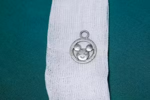 Dị vật bị mắc phía trên thực quản được lấy ra, đảm bảo an toàn cho bé Lý Đ.Đ.