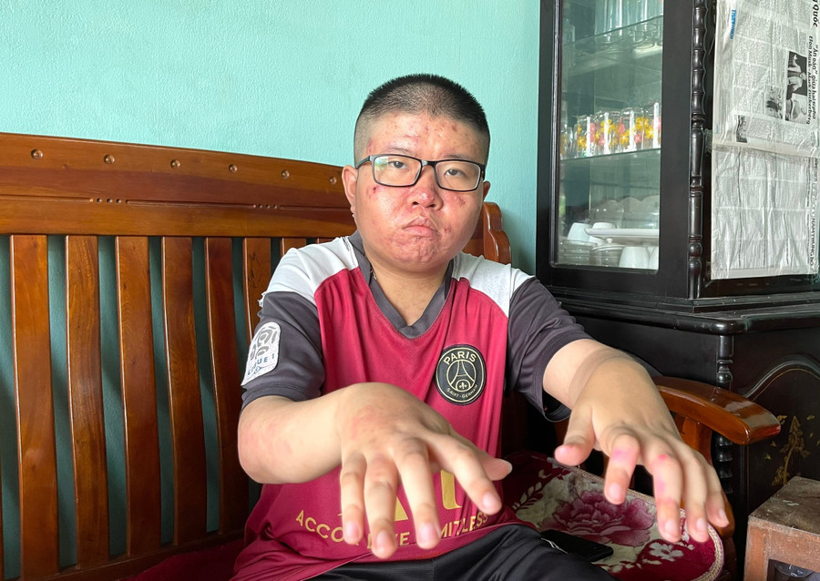 Căn bệnh viêm khớp thiếu niên hệ thống khiến đôi tay của Song Nguyên ngày càng yếu. z6935984234940-a111786e2dbfe6d8eea9fed5c8365fa4.jpg