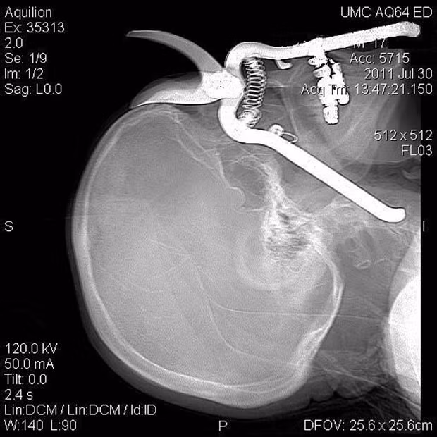 A CT scan shows a pair of pruning shears embedded in the head of an 86-year-old Green Valley, Ariz., man before it was removed by Medical Centre surgeons in Tucson. Leroy Luetscher was accidentally impaled through his eye socket after falling on the shears while working in his garden, the handle penetrating his eye socket and reaching down into his neck. He is expected to make a full recovery 