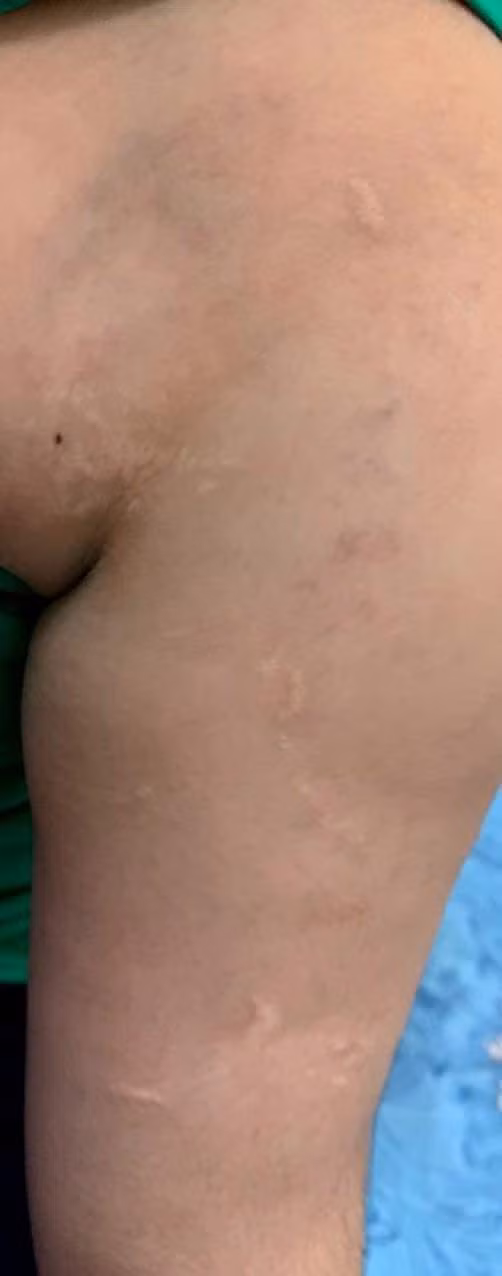 Nhiều vết thương khác trên người cháu T. khai do bị "thầy" Q. đánh. Nhiều vết thương khác trên người cháu T. khai do bị "thầy" Q. đánh.