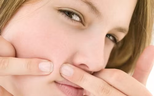 Xua tan nỗi lo trứng cá