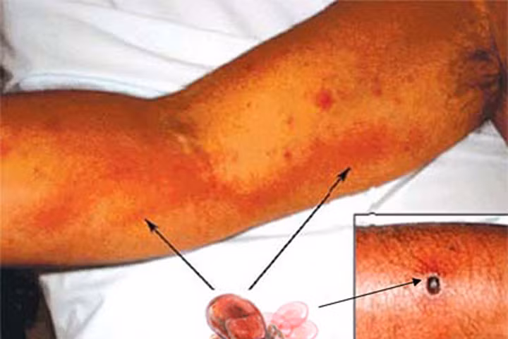 Những điều cần biết về virus gây bệnh sốt mò nguy hiểm