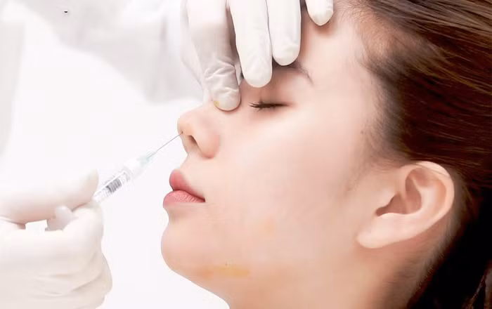 Cô gái 20 tuổi ôm mũi hoại tử đến bệnh viện cầu cứu sau khi tự tiêm filler làm đẹp