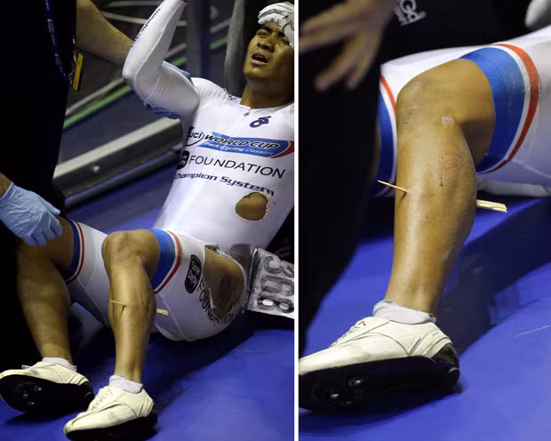 Azizulhansi Awang of Malaysia lies on the track after crashing out of the Men’s Keirin Final and sustaining a splinter through his leg during day two of the UCI Track Cycling World Cup Classic at Manchester Velodrome. He managed to remount his bike after the high-speed crash in and stagger across the line to claim a bronze medal. He was rushed to a local hospital but medics waited until Sunday to carry out the procedure to remove the 20-centimetre (7.8-inch) piece of wood from his left calf. 