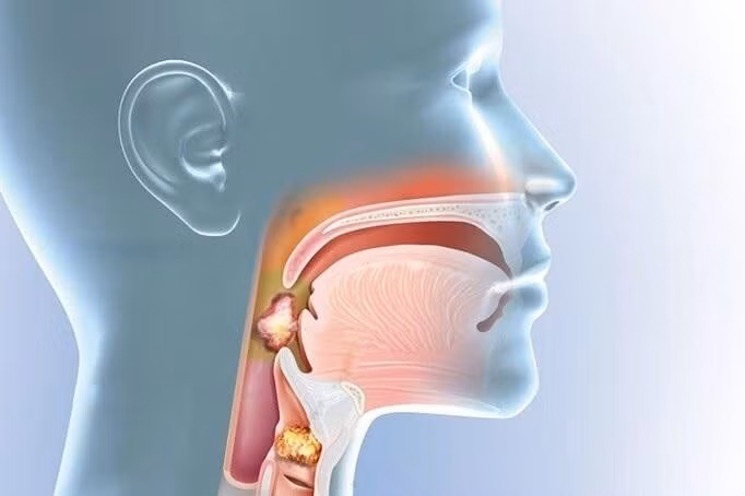 Dịch mủ chảy xuống cổ họng gây hôi miệng