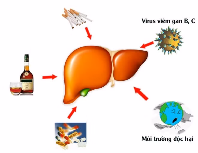 Cần biết những nguyên nhân gây nhiễm độc gan để loại trừ, phòng ngừa