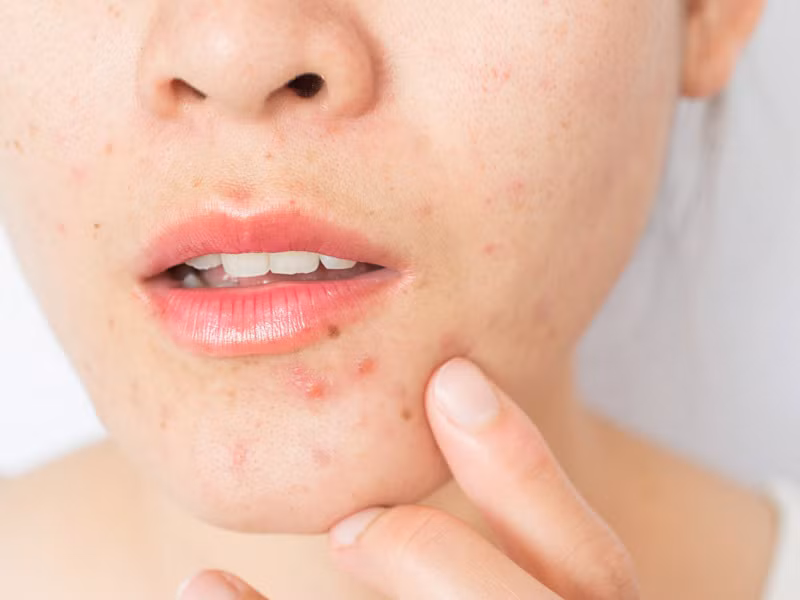 Người có làn da mụn nên tránh các loại sữa rửa mặt nhiều chất tẩy rửa
