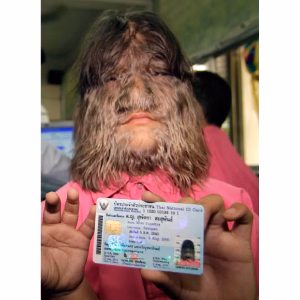 Thai school girl Supattra Sasupan, 11, the world’s hairiest girl, shows her national ID card during the first day of issuing ID cards to children aged seven to 14 nationwide at a school in Bangkok. Supattra has the very rare Ambras syndrome or Congenital Hypertrichosis meaning she has excessive hair covering her face and parts of her body.