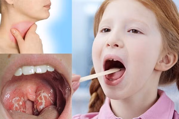 Viêm họng mạn tính ở trẻ là bệnh lý thường gặp