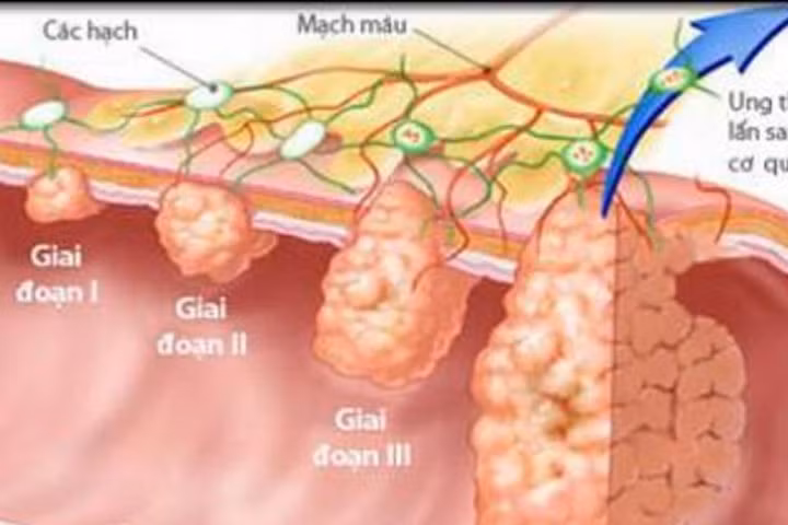 Ngăn ngừa ung thư dạ dày bằng những thực phẩm dân dã sau