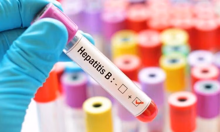 Người bị viêm gan B dương tính nên xét nghiệm định kỳ virus viêm gan B