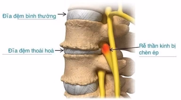 Bệnh thoái hóa đĩa đệm thắt lưng có thể ảnh hưởng đến những người trẻ tuổi