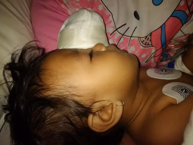 Bệnh nhi được điều trị toàn diện để bảo tồn mắt phải và có thể lắp mắt trái giả nếu có điều kiện