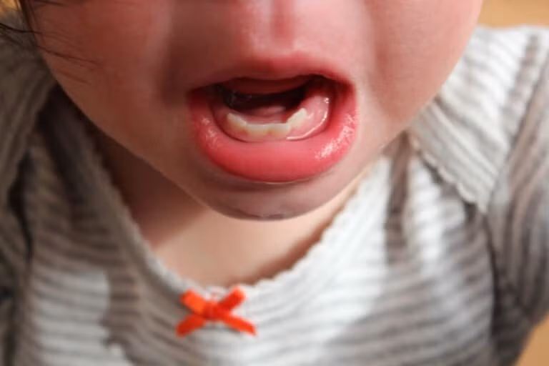 Viêm lợi ở trẻ có thể do mọc răng