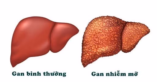 Gan nhiễm mỡ được xác định khi 5% trọng lượng là chất béo