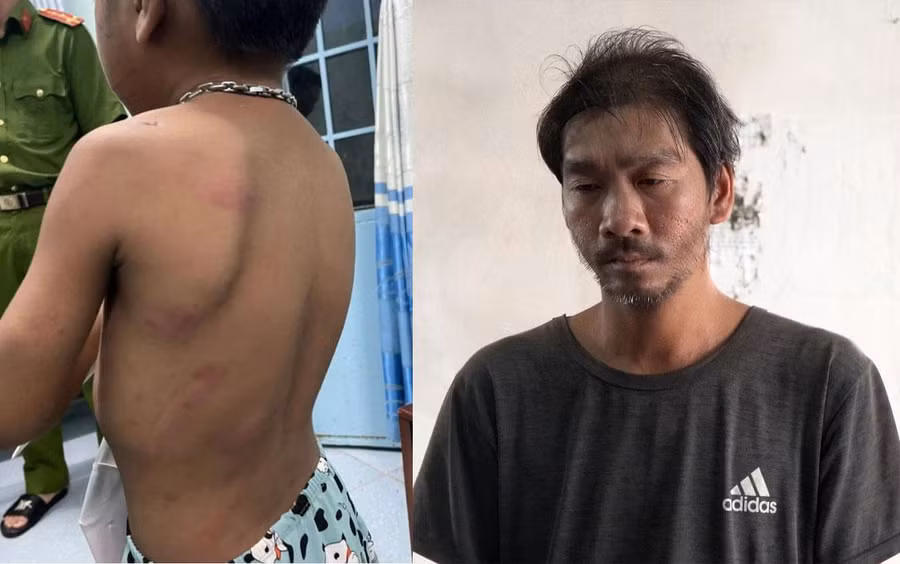 Những vết thương trên cơ thể cháu T. do đối tượng Lương Văn Luận (ảnh phải) gây ra.