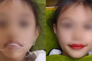 Biến chứng kinh hoàng có thể xảy ra khi xăm môi cho trẻ 5 tuổi