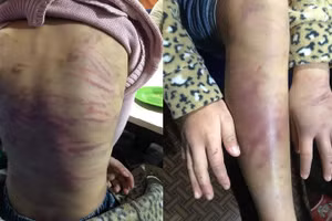 Những vết thương trên cơ thể bé gái 12 tuổi bị bạo hành.