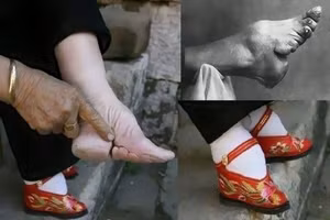 Bàn chân biến dạng do bị bó.