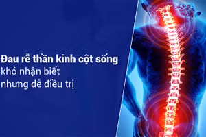Đau rễ thần kinh cột sống ảnh hưởng lớn đến sinh hoạt và công việc