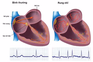 Hình ảnh tai bình thường và tai khi xuất hiện rung nhĩ.