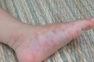 Cần phân biệt những triệu chứng của sốt xuất huyết và Covid-19 để có hướng điều trị cho trẻ. Ảnh minh họa.