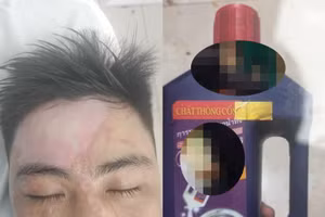 Người đàn ông bị bỏng nặng do nước thông cống.