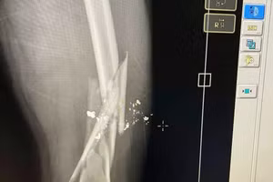 Phim chụp xương đùi bị gãy nát được cho là của nạn nhân.