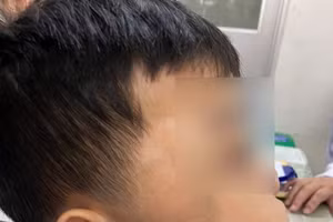Theo bác sĩ Thanh Mai đây là ca u xơ vòm mũi họng có kích thước lớn và hiếm gặp (Ảnh: BVCC).