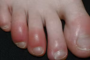 Một bệnh nhân mắc chứng cước ngón chân. Ảnh: Wikipedia