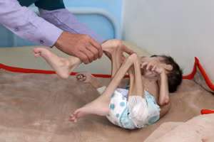 Cậu bé Faid Samim nặng 7kg vì nạn đói.