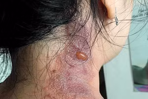 Kiến ba khoang có độc tố rất mạnh, dễ gây bỏng, viêm da khi tiếp xúc với da. 