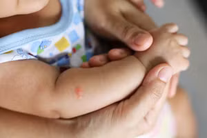 Trẻ sơ sinh mắc SXH có thể xuất hiện dấu hiệu xuất huyết dưới da, bụng, tay, chân, cổ, hay mí mắt. Ảnh minh họa.