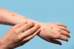 Hiệu quả tiêm chủng đậu mùa khỉ đối với người mắc HIV có thể thấp hơn. Ảnh minh họa
