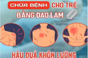 Dùng dao lam nặn (hoặc rạch) lấy máu để chữa bệnh là phương pháp hoàn toàn không có tính khoa học. Ảnh minh họa
