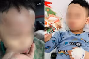 Cháu L.H.L với những vết thương trên mặt được gia đình chụp lại. 